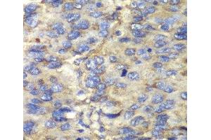 Immunohistochemistry of paraffin-embedded Human liver cancer using SDHA Polyclonal Antibody at dilution of 1:100 (40x lens). (SDHA 抗体)