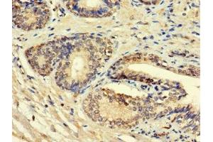 Immunohistochemistry of paraffin-embedded human prostate cancer using ABIN7156008 at dilution of 1:100 (HSD11B1L 抗体  (AA 17-87))