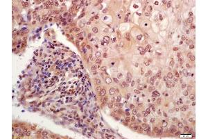 Immunohistochemistry (IHC) image for anti-Tumor Protein P53 (TP53) (pSer33) antibody (ABIN702925)