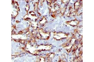 IHC staining of angiosarcoma with PECAM-1 antibody (C31. (CD31 抗体)