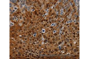 Immunohistochemistry of Human thyroid cancer using NRP2 Polyclonal Antibody at dilution of 1:35 (NRP2 抗体)