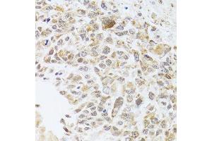 Immunohistochemistry of paraffin-embedded human lung cancer using RNASEL antibody. (RNASEL 抗体  (AA 472-741))