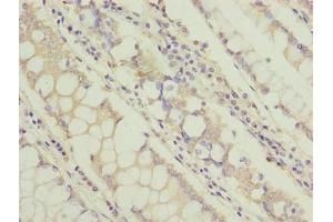 Immunohistochemistry of paraffin-embedded human colon cancer using ABIN7171349 at dilution of 1:100 (TCTA 抗体  (AA 62-103))