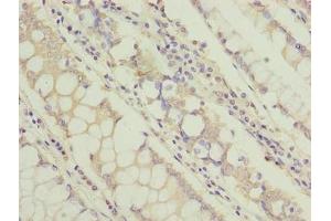 Immunohistochemistry of paraffin-embedded human colon cancer using ABIN7171349 at dilution of 1:100