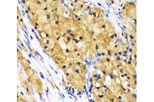 Immunohistochemistry of paraffin-embedded Human lung cancer using CAPG Polyclonal Antibody at dilution of 1:100 (40x lens). (CAPG 抗体)