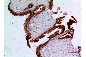 Immunohistochemistry (IHC) analysis of paraffin-embedded Human Prostatic Cancer, antibody was diluted at 1:100. (Angiopoietin 1 抗体  (N-Term))