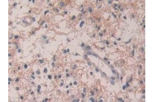 Detection of IL35 in Human Glioma Tissue using Polyclonal Antibody to Interleukin 35 (IL35) (Interleukin 35 抗体  (AA 23-219))