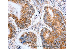 Immunohistochemistry of Human liver cancer using CLDN10 Polyclonal Antibody at dilution of 1:50 (CLDN10 抗体)