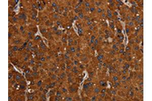 The image on the left is immunohistochemistry of paraffin-embedded Human liver cancer tissue using ABIN7192423(SLC22A12 Antibody) at dilution 1/20, on the right is treated with synthetic peptide. (SLC22A12 抗体)