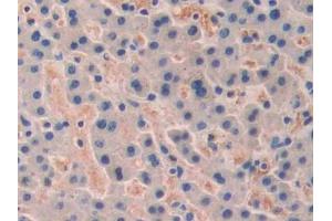 DAB staining on IHC-P; Samples: Human Liver cancer Tissue (TRF1 抗体  (AA 148-428))