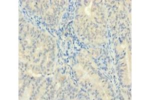 Immunohistochemistry of paraffin-embedded human endometrial cancer using ABIN7176084 at dilution of 1:100 (ZMAT5 抗体  (AA 1-170))
