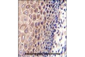 CCDC97 Antibody (C-term) (ABIN655301 and ABIN2844887) immunohistochemistry analysis in formalin fixed and paraffin embedded human esophageal carcinoma followed by peroxidase conjugation of the secondary antibody and DAB staining. (CCDC97 抗体  (C-Term))