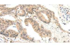 Immunohistochemistry of paraffin-embedded Human colon cancer tissue using RRAD Polyclonal Antibody at dilution 1:50 (RRAD 抗体)
