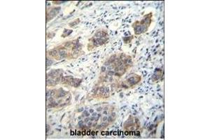 CDH24 Antibody (N-term) (ABIN656094 and ABIN2845437) immunohistochemistry analysis in formalin fixed and paraffin embedded human bladder carcinoma followed by peroxidase conjugation of the secondary antibody and DAB staining. (Cadherin 24 抗体  (N-Term))