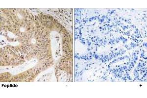 Immunohistochemistry analysis of paraffin-embedded human colon carcinoma tissue using DAP polyclonal antibody . (DAP 抗体)