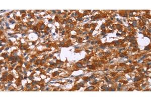 Immunohistochemistry of paraffin-embedded Human thyroid cancer tissue using GPHN Polyclonal Antibody at dilution 1:30 (Gephyrin 抗体)