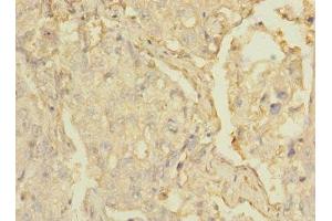 Immunohistochemistry of paraffin-embedded human lung cancer using ABIN7158886 at dilution of 1:100 (MARCO 抗体  (AA 421-520))