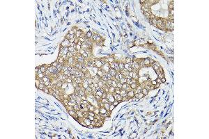 Immunohistochemistry of paraffin-embedded human breast cancer using OL Rabbit pAb (1671) at dilution of 1:100 (40x lens). (OLA1 抗体  (AA 297-396))