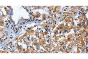Immunohistochemistry of paraffin-embedded Human thyroid cancer using CD244 Polyclonal Antibody at dilution of 1:50 (2B4 抗体)