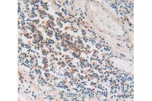 IHC-P analysis of stomach cancer tissue, with DAB staining. (PKIG 抗体  (AA 1-76))