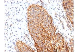 Formalin-fixed, paraffin-embedded human Bladder Carcinoma stained with Thrombomodulin Monoclonal/CD141 Antibody (THBD/1591). (Thrombomodulin 抗体  (AA 69-194))