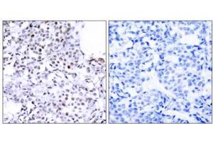Immunohistochemical analysis of paraffin-embedded human breast carcinoma tissue using SMC1 (Ab-957) antibody (E021190). (SMC1A 抗体)