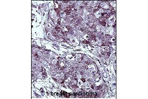 TYSY Antibody (C-term) immunohistochemistry analysis in formalin fixed and paraffin embedded human breast carcinoma followed by peroxidase conjugation of the secondary antibody and DAB staining. (TYMS 抗体  (C-Term))