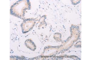 Immunohistochemistry of Human thyroid cancer using MAP3K12 Polyclonal Antibody at dilution of 1:30 (MAP3K12 抗体)