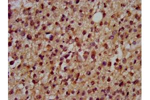 IHC image of ABIN7150649 diluted at 1:200 and staining in paraffin-embedded human glioma performed on a Leica BondTM system. (DSCAM 抗体  (AA 1711-1867))