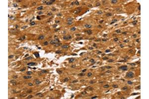 The image on the left is immunohistochemistry of paraffin-embedded Human liver cancer tissue using ABIN7192726(TACC2 Antibody) at dilution 1/30, on the right is treated with synthetic peptide. (TACC2 抗体)