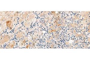 Immunohistochemistry of paraffin-embedded Human liver cancer tissue using THNSL1 Polyclonal Antibody at dilution of 1:70(x200) (THNSL1 抗体)