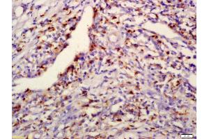 Formalin-fixed and paraffin embedded human laryngocarcinoma labeled with Anti-PPM1D Polyclonal Antibody, Unconjugated (ABIN740415) at 1:200 followed by conjugation to the secondary antibody and DAB staining