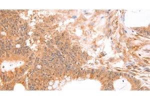 Immunohistochemistry of paraffin-embedded Human colon cancer tissue using TNF beta Polyclonal Antibody at dilution 1:50 (LTA 抗体)