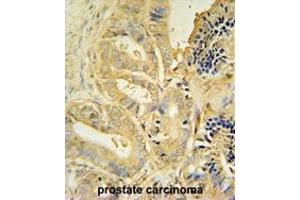 TLL1 antibody (C-term) immunohistochemistry analysis in formalin fixed and paraffin embedded human prostate carcinoma followed by peroxidase conjugation of the secondary antibody and DAB staining. (TLL1 抗体  (C-Term))