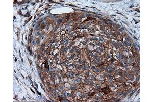 Immunohistochemical staining of paraffin-embedded Carcinoma of liver tissue using anti-RC201933 mouse monoclonal antibody. (PIM2 抗体)