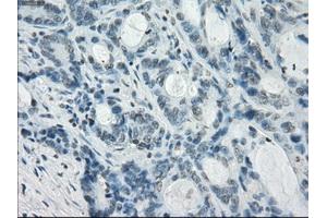 Immunohistochemical staining of paraffin-embedded Adenocarcinoma of colon tissue using anti-CRYABmouse monoclonal antibody. (CRYAB 抗体)