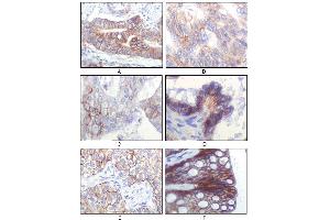 Immunohistochemical analysis of paraffin-embedded human gastric adenocarcinoma(A), colon adenocarcinoma(B), endometrial carcinoma(uterus)(C), ovary adenocarcinoma(D), lung squamous cell carcinoma(E), stomach epithelium mucosae(F), showing membrane localization using IGF1R-Beta mouse mAb with DAB staining. (IGF1R-beta 抗体)