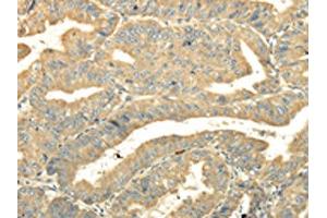 The image on the left is immunohistochemistry of paraffin-embedded Human esophagus cancer tissue using ABIN7131516(TULP2 Antibody) at dilution 1/20, on the right is treated with fusion protein. (TULP2 抗体)