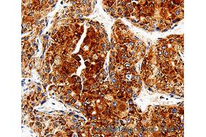 Immunohistochemistry of Human liver cancer using COX19 Polyclonal Antibody at dilution of 1:50 (COX19 抗体)