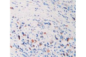 IHC-P analysis of stomach cancer tissue, with DAB staining. (FIL1d 抗体  (AA 12-151))