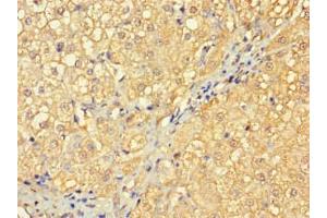 Immunohistochemistry of paraffin-embedded human liver cancer using ABIN7166961 at dilution of 1:100 (RABGAP1L 抗体  (Isoform 10))