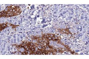 ABIN6278038 at 1/100 staining Human Head and neck cancer tissue by IHC-P. (CD72 抗体  (Internal Region))