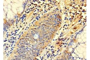 Immunohistochemistry of paraffin-embedded human colon cancer using ABIN7171165 at dilution of 1:100 (SYTL3 抗体  (AA 1-300))