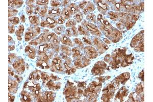 Formalin-fixed, paraffin-embedded human Stomach Carcinoma stained with MUC1 Rabbit Recombinant Monoclonal Antibody (MUC1/2818R). (Recombinant MUC1 抗体)