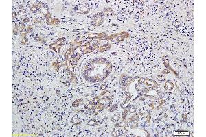 Formalin-fixed and paraffin embedded human colon cancer labeled with Anti-EDG4/LPA2 Polyclonal Antibody, Unconjugated (ABIN681118) at 1:400 followed by conjugation to the secondary antibody and DAB staining (EDG4 抗体)