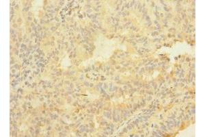 Immunohistochemistry of paraffin-embedded human endometrial cancer using ABIN7144765 at dilution of 1:100 (ASTL 抗体  (AA 38-337))