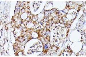 Immunohistochemistry of paraffin-embedded Human colon carcinoma using CDK5RAP1 Polyclonal Antibody at dilution of 1:100 (40x lens). (CDK5RAP1 抗体)