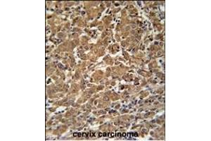 N4BP3 Antibody (N-term) (ABIN651821 and ABIN2840413) immunohistochemistry analysis in formalin fixed and paraffin embedded human cervix carcinoma followed by peroxidase conjugation of the secondary antibody and DAB staining. (N4BP3 抗体  (N-Term))