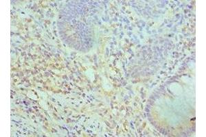 Immunohistochemistry of paraffin-embedded human colon cancer using ABIN7171057 at dilution of 1:100 (SMARCC2 抗体  (AA 300-650))