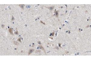 ABIN6272845 at 1/100 staining Human brain cancer tissue by IHC-P. (IFT88 抗体  (C-Term))